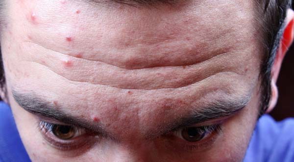 la frente de una persona con acné